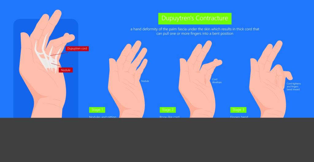 Graphic of the stages of dupuytren’s contracture in hand on blue background