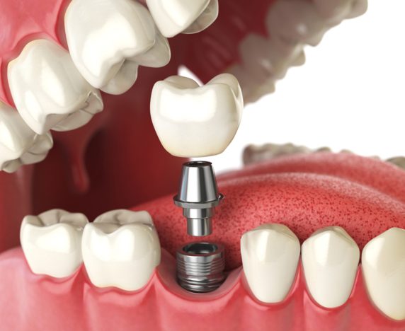 Dental Implant Q & A