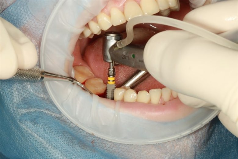 Dental implants mission viejo